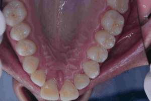 Overjet front teeth - Protruding Upper Jaw