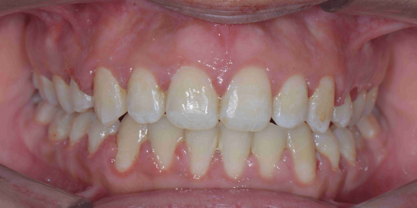 Overjet front teeth - Protruding Upper Jaw