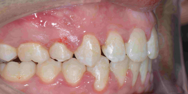 Overjet front teeth - Protruding Upper Jaw