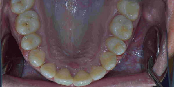 Overjet front teeth - Protruding Upper Jaw