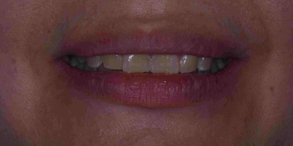 Veneer for Dark teeth - Hollywood Smile