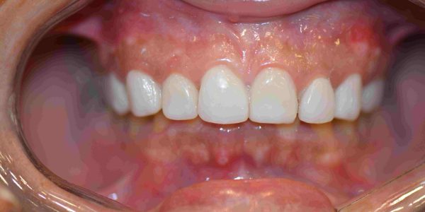 Veneer for Dark teeth - Hollywood Smile