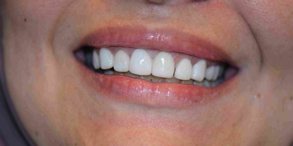 Veneer for Dark teeth - Hollywood Smile