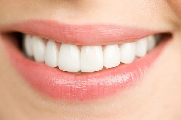 إبتسامة هوليود - Hollywood Smile