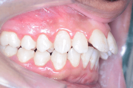Overjet front teeth - Protruding Upper Jaw