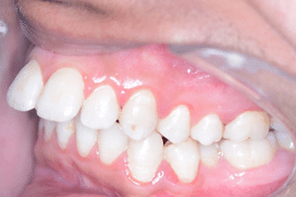 Overjet front teeth - Protruding Upper Jaw