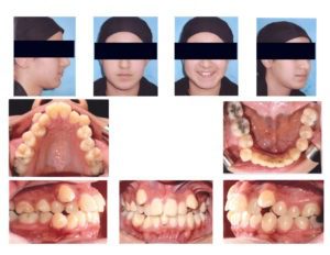 crowding upper and lower jaw - Orthodontic in Egypt - Metal Braces
