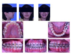 crowding upper and lower jaw - Orthodontic in Egypt - Metal Braces
