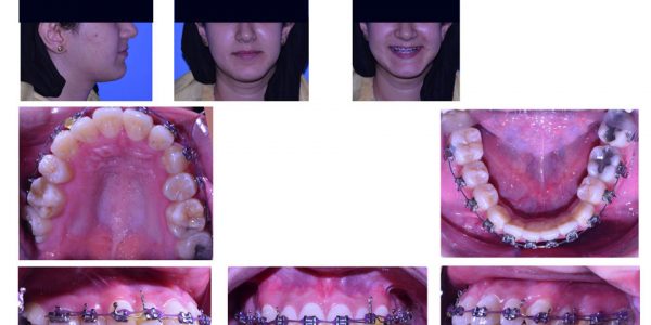 تقويم الأسنان - تقويم الأسنان فى مصر - ازدحام الاسنان العلوية والسفلية - تقويم الأسنان المعدني - مركز وندرز لعلاج الاسنان
