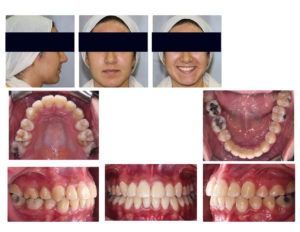 crowding upper and lower jaw - Orthodontic in Egypt - Metal Braces