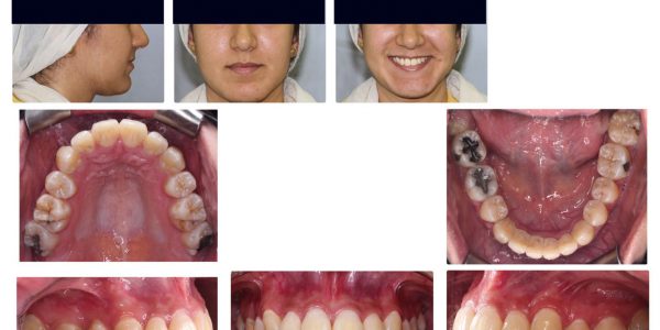 تقويم الأسنان - تقويم الأسنان فى مصر - ازدحام الاسنان العلوية والسفلية - تقويم الأسنان المعدني - مركز وندرز لعلاج الاسنان