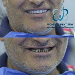 Upper teeth lost - Dental Implants - Dental Implants in Egypt - Upper Jaw Dental Implants
