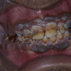 Dental Crown and Bridge - Fixed Dentures