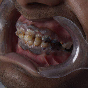 Dental Crown and Bridge - Fixed Dentures
