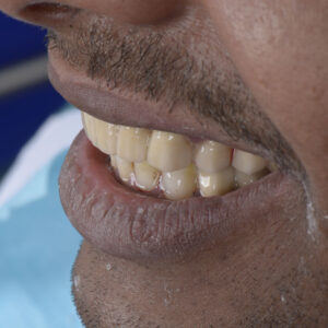 Dental Crown and Bridge - Fixed Dentures