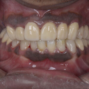 Dental Crown and Bridge - Fixed Dentures