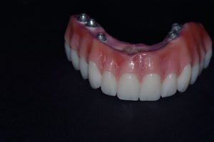 Upper teeth lost - Upper Jaw Dental Implants