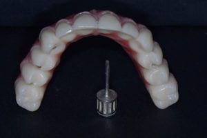 Upper teeth lost - Upper Jaw Dental Implants