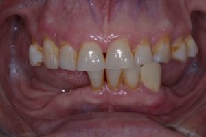 Lost lower teeth - Lower Jaw Dental Implants