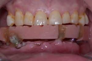 Lost lower teeth - Lower Jaw Dental Implants