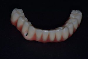 Lost lower teeth - Lower Jaw Dental Implants