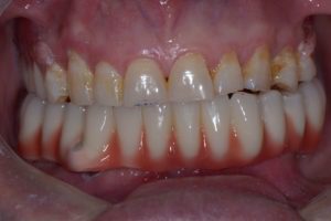 Lost lower teeth - Lower Jaw Dental Implants