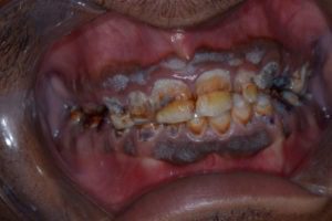 Teeth decayed and destructed - Zirconia Dental Prosthetics