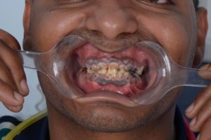 Teeth decayed and destructed - Zirconia Dental Prosthetics