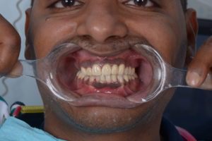 Teeth decayed and destructed - Zirconia Dental Prosthetics