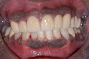 Teeth decayed and destructed - Zirconia Dental Prosthetics
