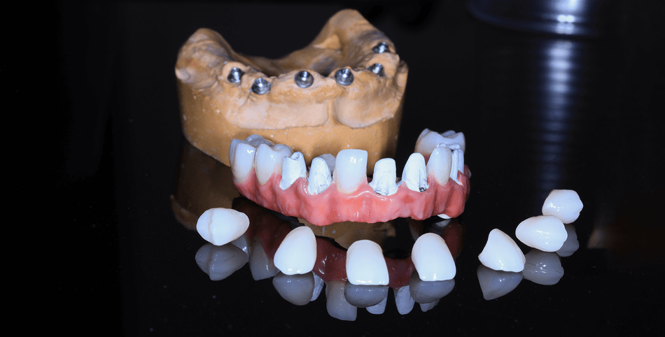 زراعة الأسنان كاملة - مركز وندرز لعلاج الاسنان - Full mouth dental implants