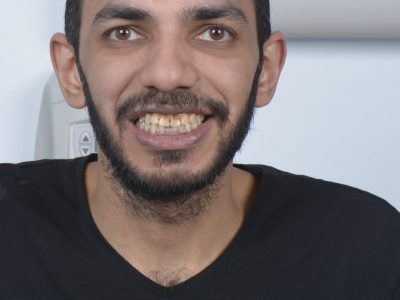 عدسات الأسنان ايماكس - مركز وندرز لعلاج الاسنان