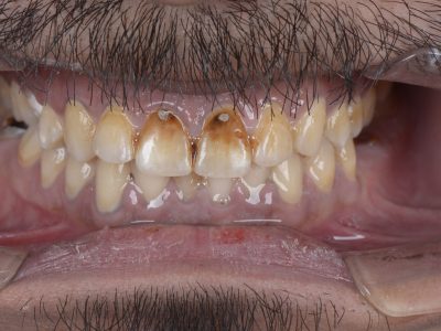 عدسات الأسنان ايماكس - مركز وندرز لعلاج الاسنان
