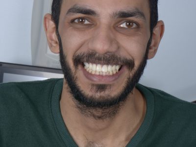 عدسات الأسنان ايماكس - مركز وندرز لعلاج الاسنان