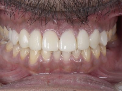 عدسات الأسنان ايماكس - مركز وندرز لعلاج الاسنان