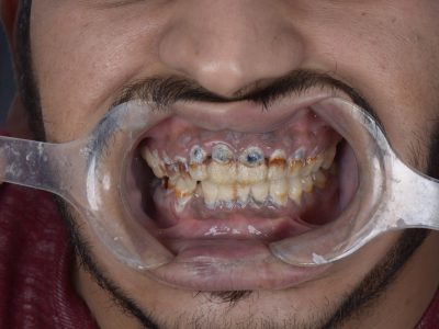 إصلاح الأسنان - مركز وندرز لعلاج الاسنان