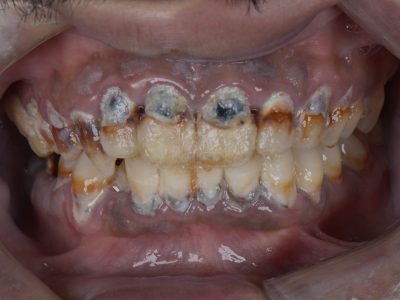 إصلاح الأسنان - مركز وندرز لعلاج الاسنان