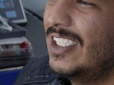 إصلاح الأسنان - مركز وندرز لعلاج الاسنان