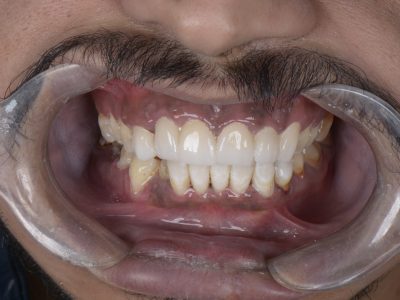 إصلاح الأسنان - مركز وندرز لعلاج الاسنان