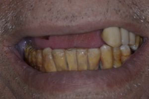 Lost upper teeth - Jawbone Resorption