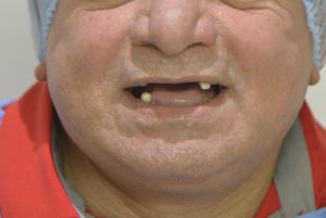 Severe infections and excruciating pain - BioHPP Dental Prosthetics