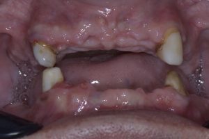 Severe infections and excruciating pain - BioHPP Dental Prosthetics