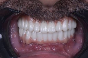 Lost upper teeth - Jawbone Resorption