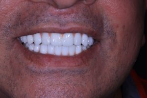 Severe infections and excruciating pain - BioHPP Dental Prosthetics