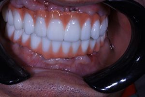BioHPP Dental Prosthetics