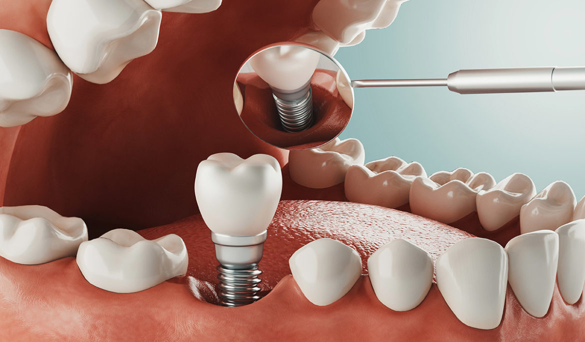 أضرار زراعة الأسنان - Side Effects of Dental Implants