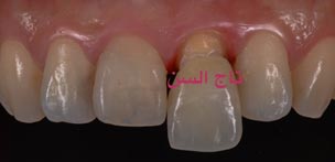 التركيبات الثابتة للاسنان - Fixed Dentures