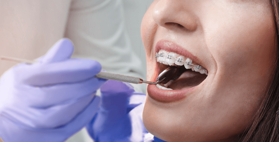 اضرار تقويم الأسنان - مركز وندرز لعلاج الاسنان - disadvantages of orthodontics