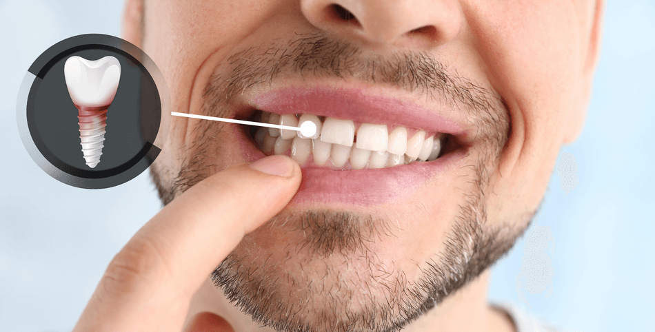 فشل زراعة الاسنان - مركز وندرز لعلاج الاسنان