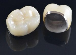 انواع تركيبات الأسنان - Types of dental prosthetics